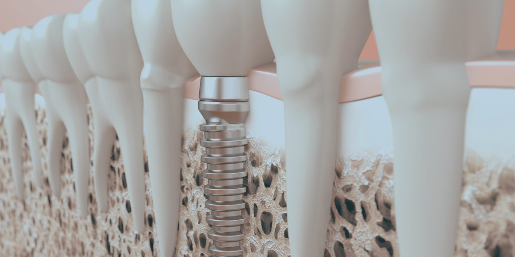 Bone grafting illustration