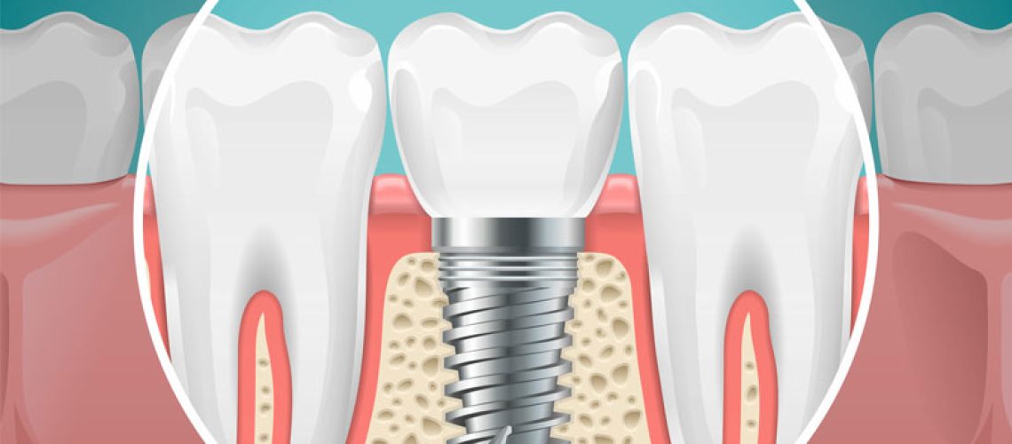 2d graphic of a single dental implant between two natural teeth.