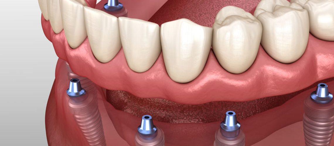 Image of an implant supported dental model.